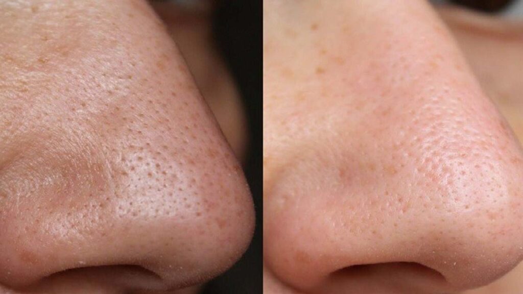 نمونه تصویر جوش بینی قبل و بعد