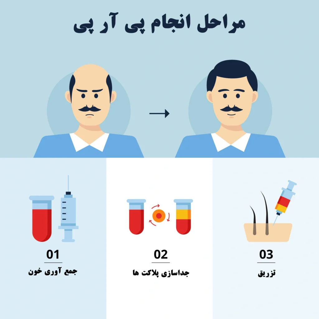 مراحل تزریق PRP