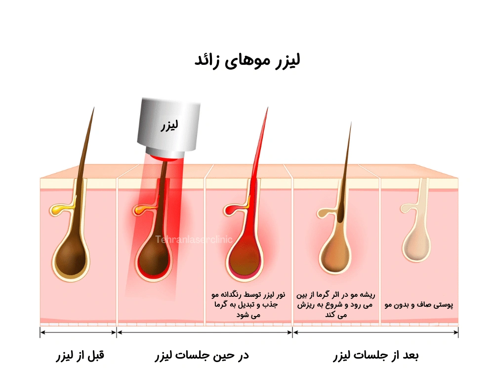 مراحل لیزر موهای زائد