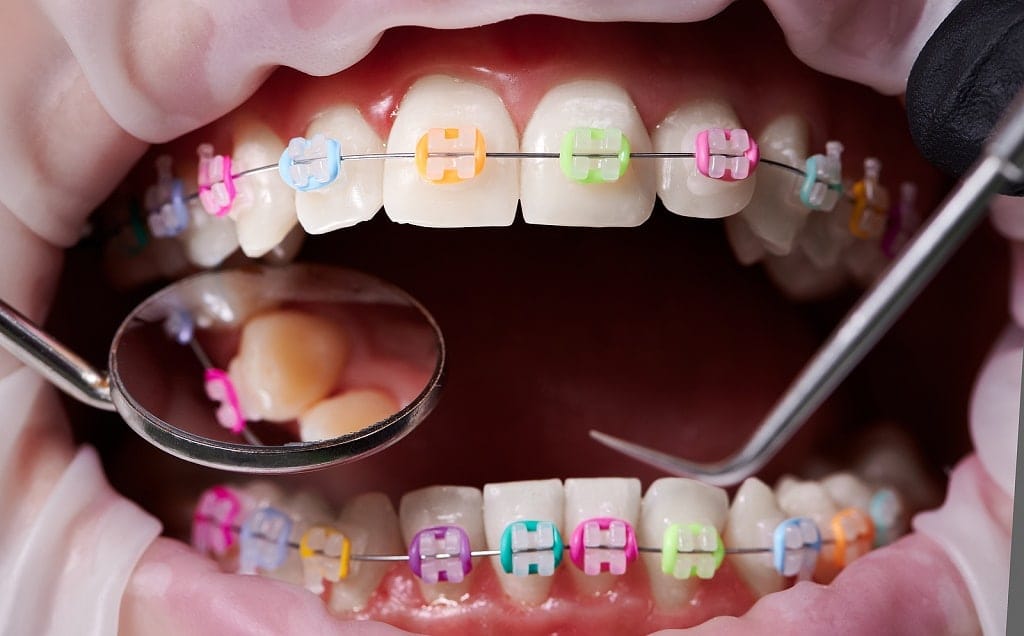 Macro Snapshot Of Open Mouth, Teeth, Ceramic Braces With Colorfu