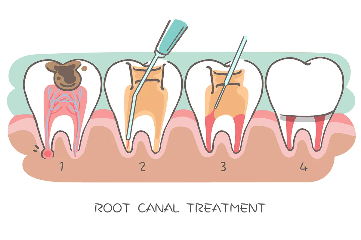 Root Canal Treatment