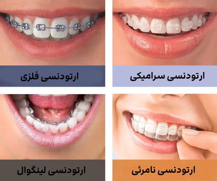 انواع ارتودنسی دندان