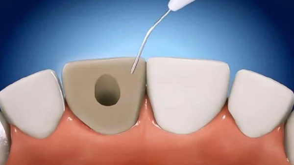 تصویر Internal Bleaching