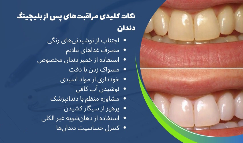 تصویر مراقبت‌های بعد از بلیچینگ دندان