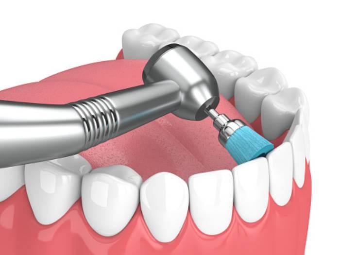 عکس جرم گیری دندان - با دستگاه گرافیکی