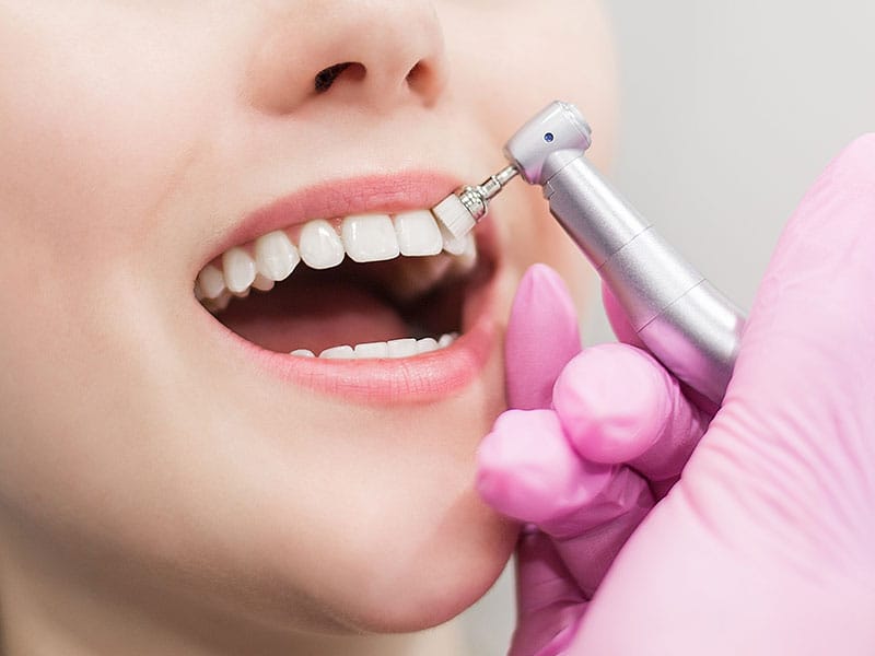 عکس جرم گیری دندان - با دستگاه