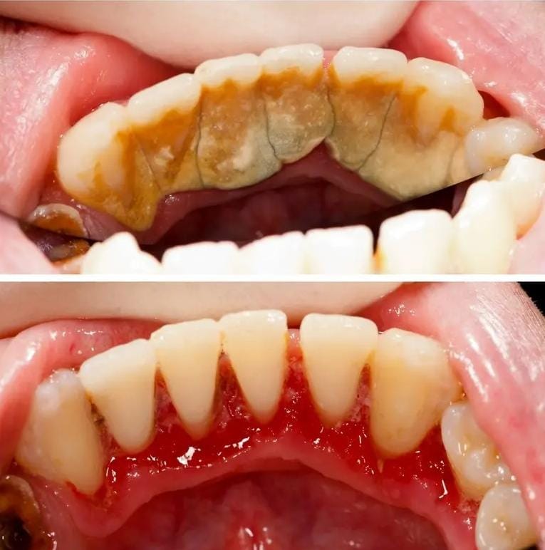 نمونه تصویر قبل و بعد جرم گیری دندان