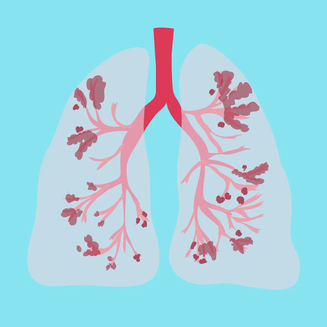 COPD انسداد ریوی