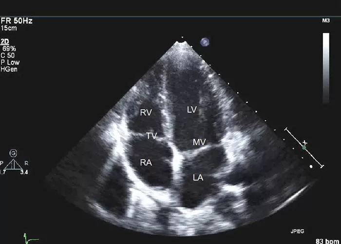 اکوکاردیوگرافی چیست؟