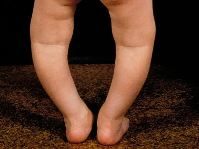 درمان پای پرانتزی