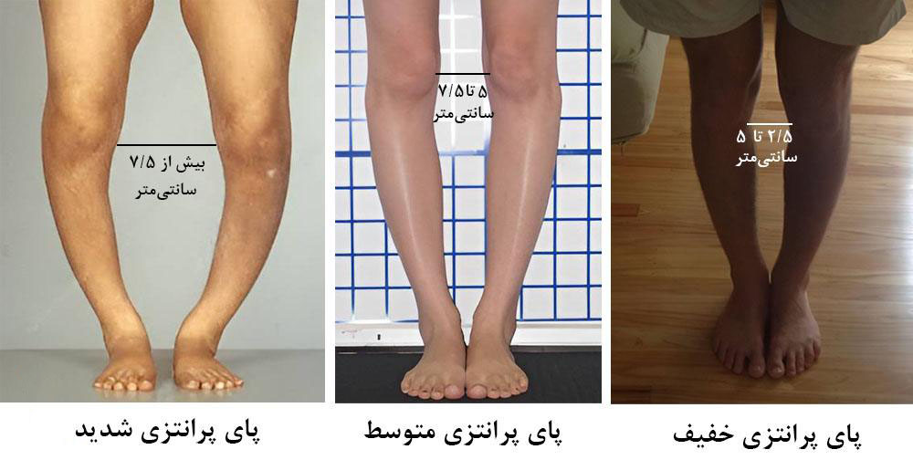 شدت های پای پرانتزی