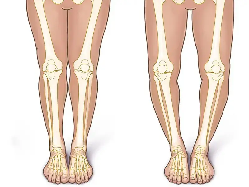 پای پرانتزی در کودکان