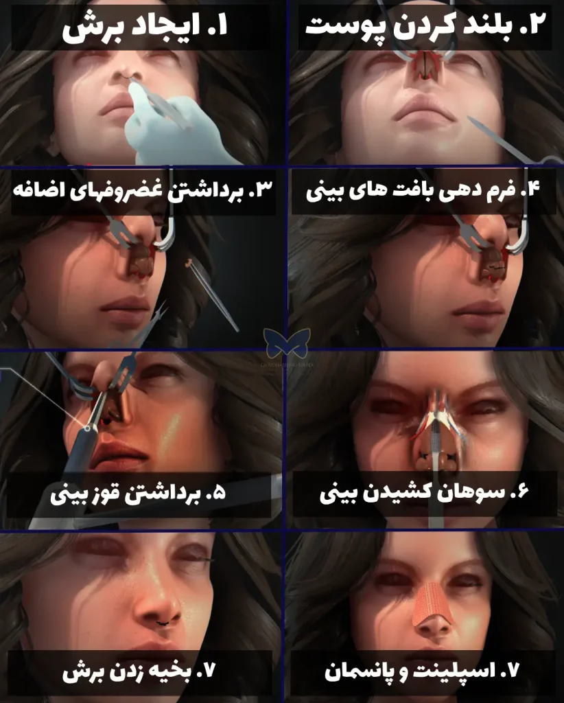 مراحل عمل بینی