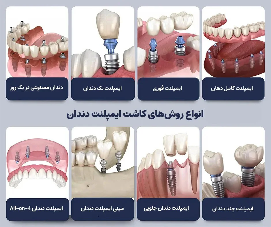 انواع ایمپلنت‌های دندانی