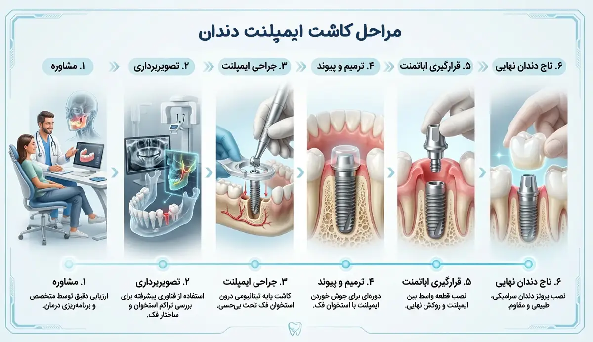 فرآیند کاشت ایمپلنت دندانی