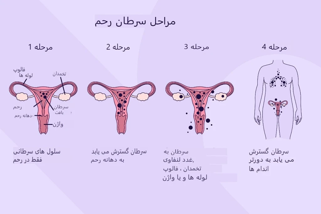 مراحل سرطان دهانه رحم