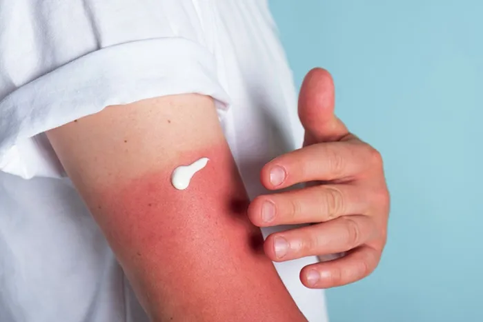 SubBurn