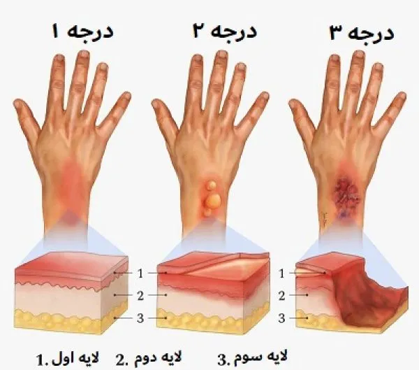 انواع آفتاب سوختگی