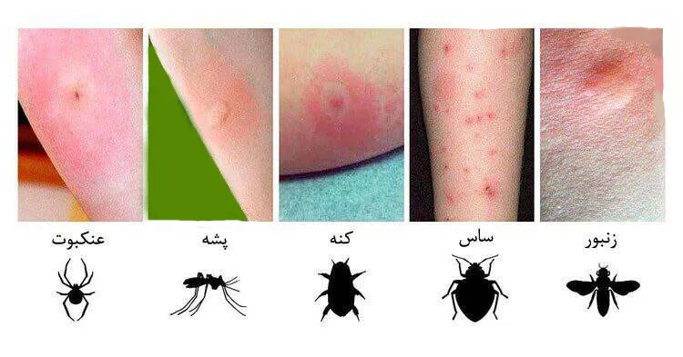 انواع حشرات گزنده در تابستان