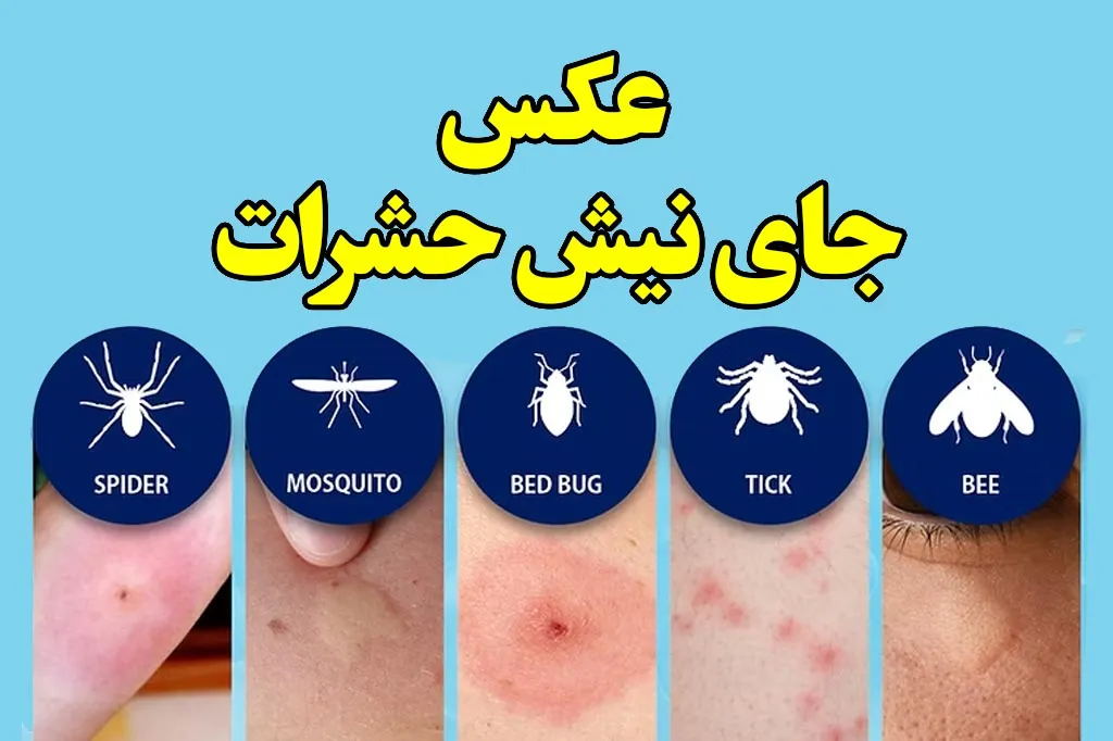 عکس جای نیش حشرات