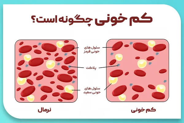 کم خونی چگونه است